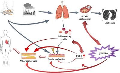 Analysis of pathogenesis and drug treatment of chronic obstructive pulmonary disease complicated with cardiovascular disease
